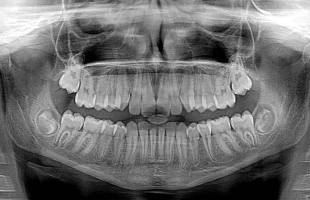 Dentist-Toa-Payoh-OPG-X-ray